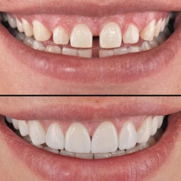 Съемные виниры каппы для зубов Perfect Smile Veneers белые